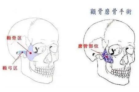 颧骨骨折伤残鉴定